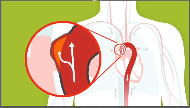 Aortic Aneurysm and Dissection | The Heart-Related Emergency Few People Know About